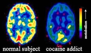 Scanned brain of addicts